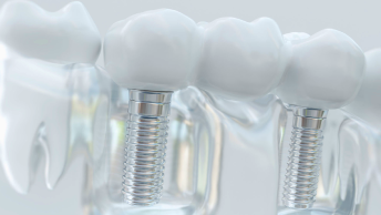 All On 4 Dental Implants Are Worth The Cost For Two Reasons