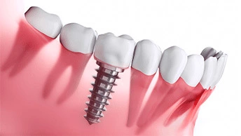 The Average Prices For A Single Tooth & Full Mouth Implants