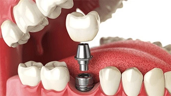 What Are The Differences Between Dentures And Dental Implants?