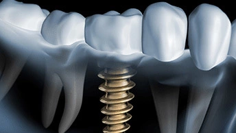 What Is The Average Cost Of Dental Implants In The UK?