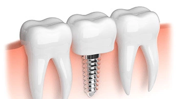 What You Need To Know About Dental Implants Costs